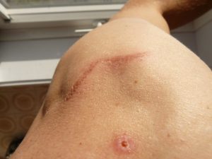 scars