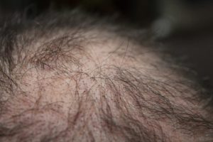 Hair loss